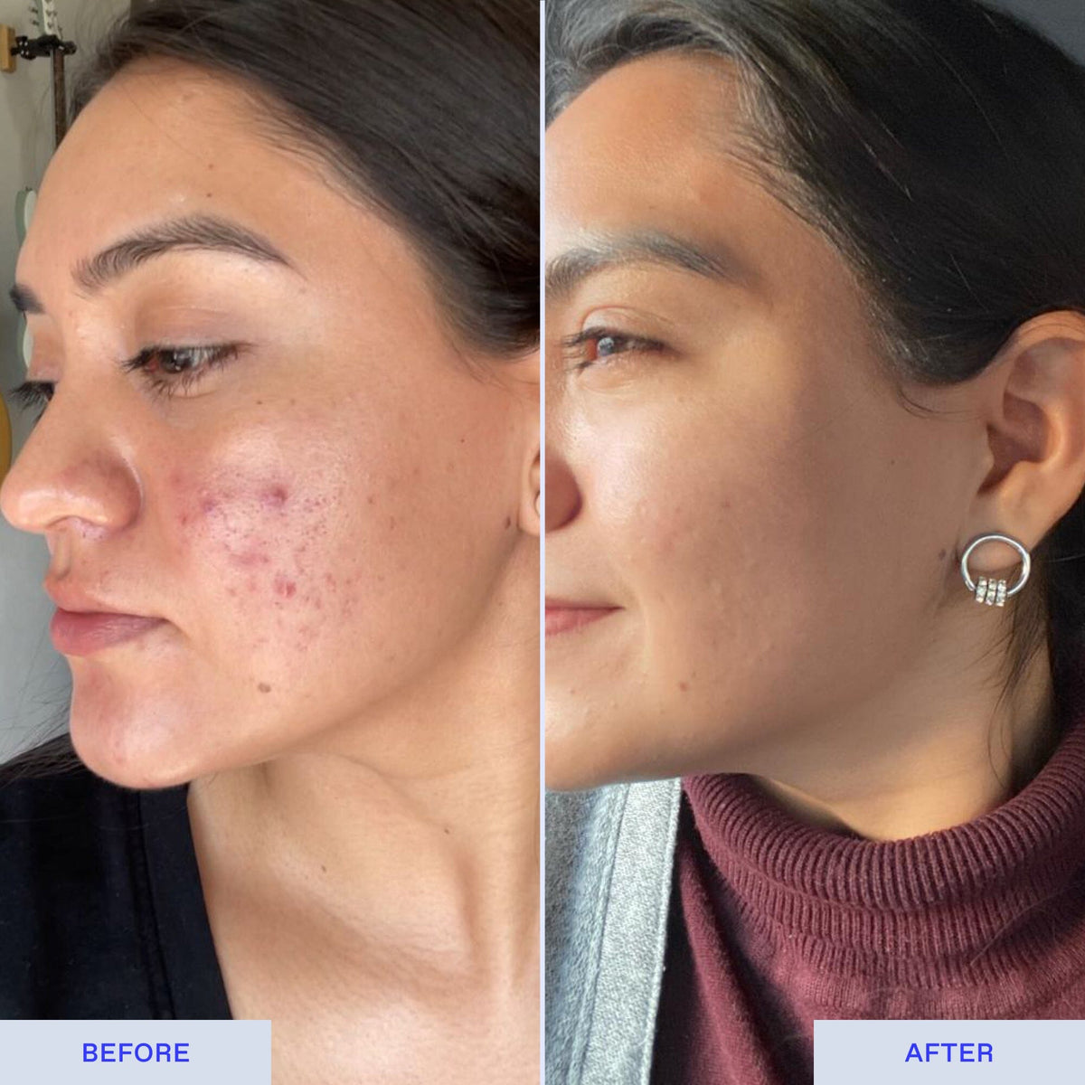 Ultra Acne Relief InvisaMask Sheet Mask BioRepublic SkinCare | The Best Sheet Masks 